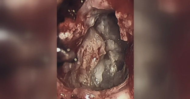During keyhole surgery, Shahinian discovered a teratoma, also known as an embryonic twin, in Karanam’s brain.