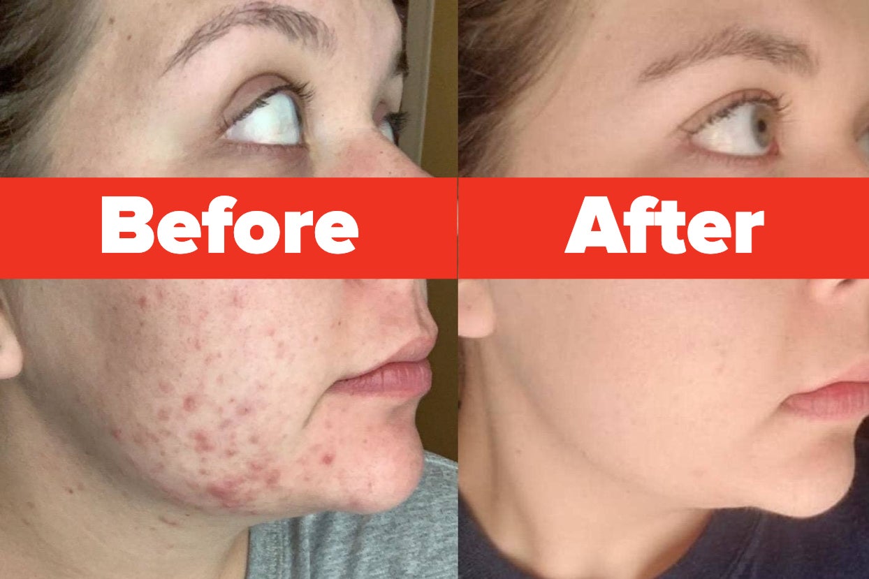 Reviewer before and after showing the product dramatically cleared up the acne scars and breakouts on their cheek