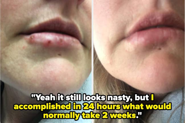 Two side-by-side close-up images show lip healing progress. The text below reads,