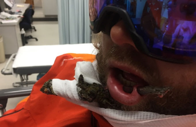 A snowboarder whose lip was impaled.