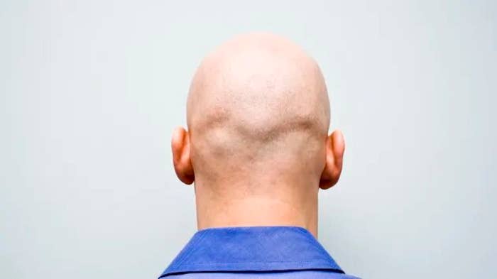 U.K. employment ruling determines calling a man &quot;bald&quot; is sexual harassment