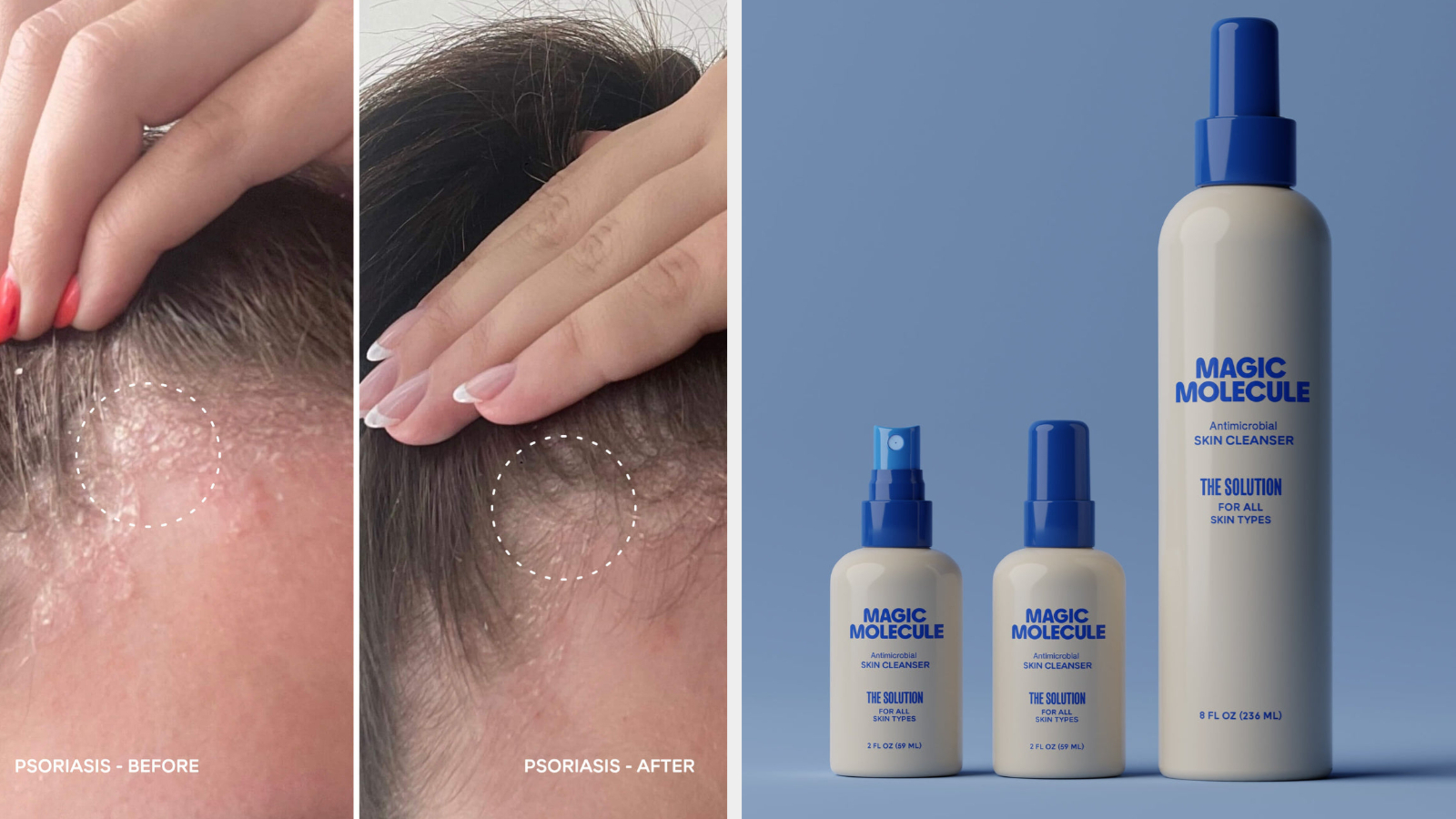 Before and after shots of scalp psoriasis treatment, alongside three Magic Molecule skincare products