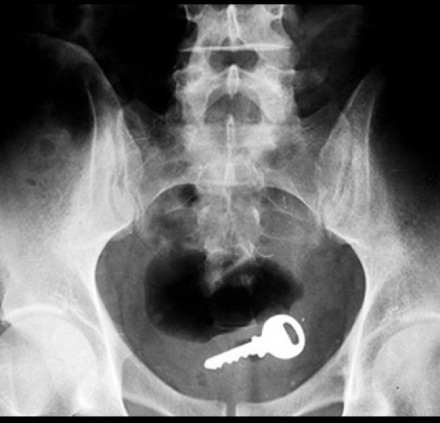 Wilhelm Röntgen developed Röntgen rays, which led to the X-ray machine. Infinitely useful: both for medicinal purposes, and for recovering lost items!