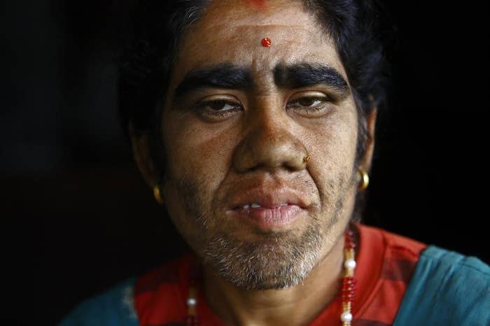 25 Incredible Images Of A Family Living With Werewolf Syndrome