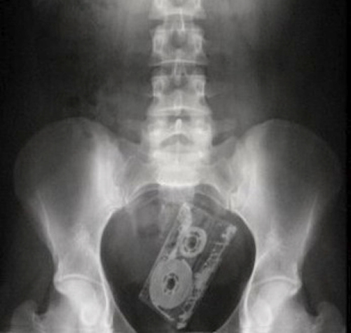 Image result for gun up butt xray