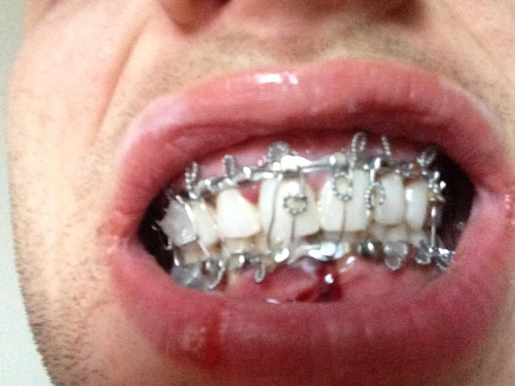 Jaw Surgery Mouth Wired Shut