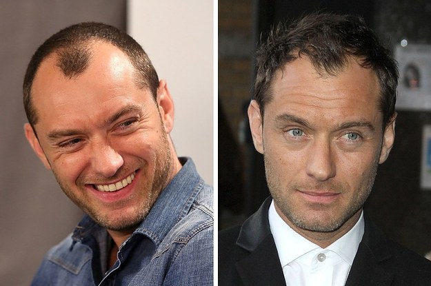 celebrity hair transplant before and after