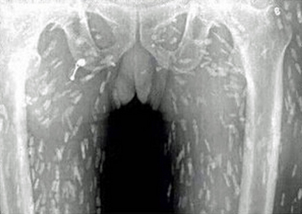 tapeworm in humans xray