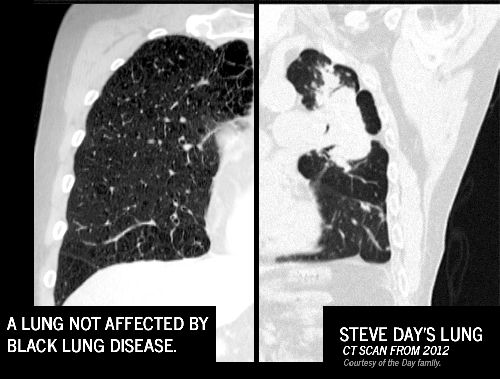 Who was right and who was wrong: See a comparison of what doctors said about Steve Day's lungs — and what the autopsy proved.