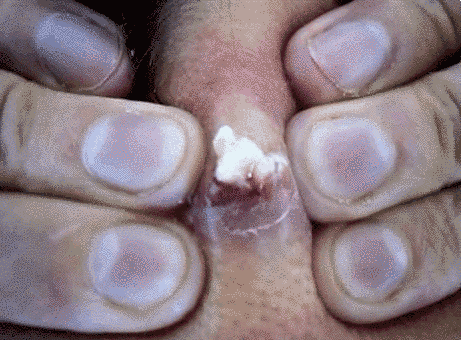 popping cysts gifs
