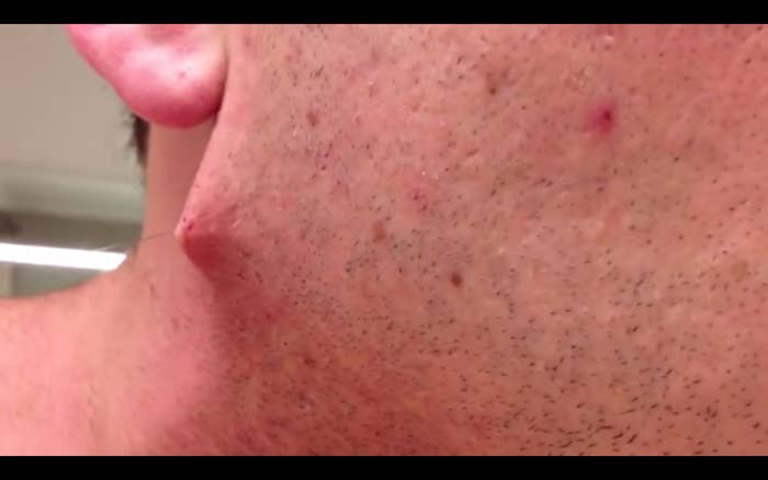 This Guy Has The Most Insane Ingrown Hair You Ve Ever Seen