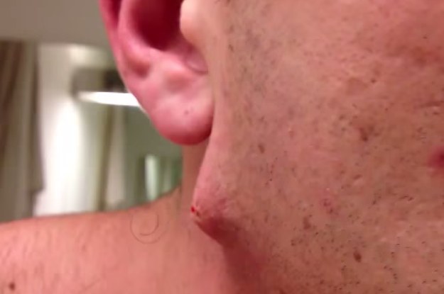 This Guy Has The Most Insane Ingrown Hair You've Ever Seen