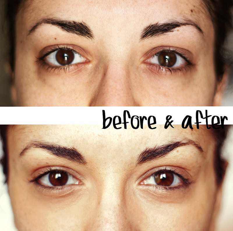 Under Eye Bags Removal | Dr Mahsa Sohrab