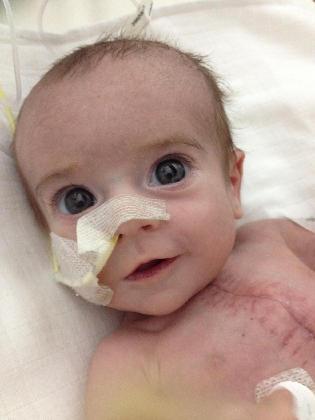 This Miracle Baby Has Survived A Stroke, Nine Operations And Had To Be ...