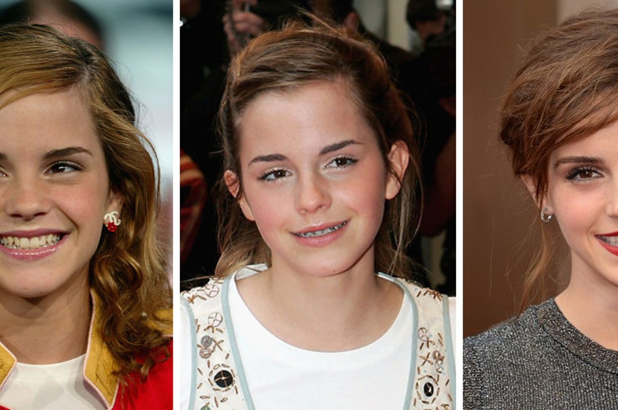 14 Celebrities Who Prove Braces Can Change Your Entire Face