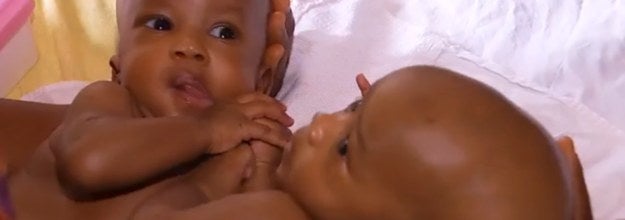 Deux Freres Siamois Guineens Separes Avec Succes A Paris