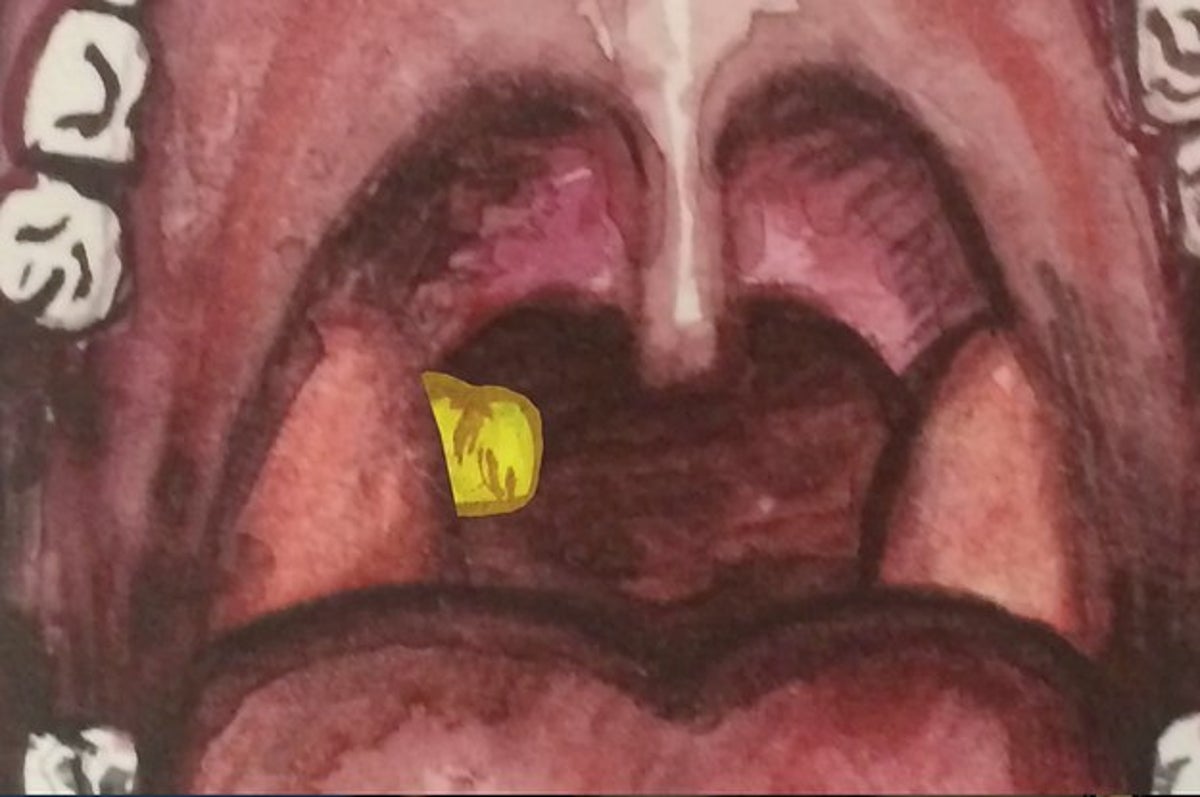 What are tonsil stones — and how do you know if you have them?