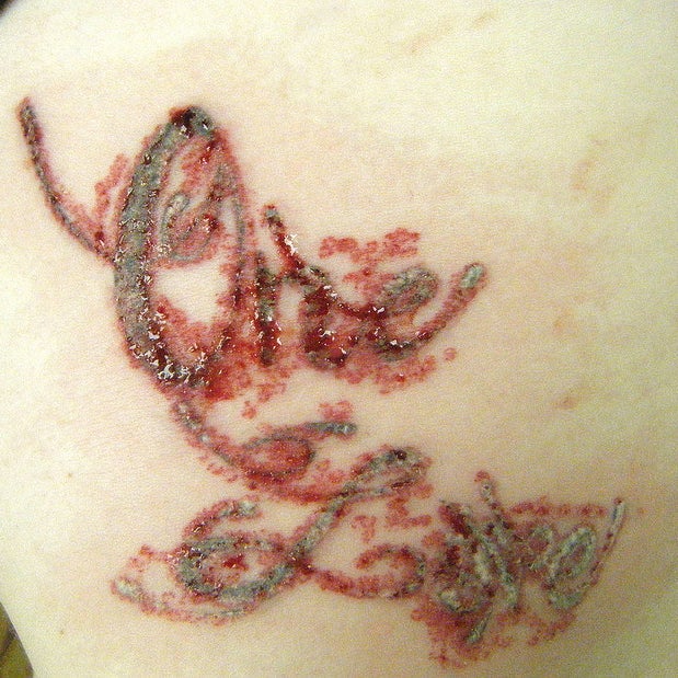 This Is What Actually Happens When You Remove A Tattoo