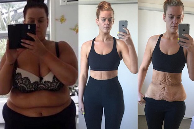 Woman Who Proved Her Haters Wrong Gets Surgery To Remove Excess Skin