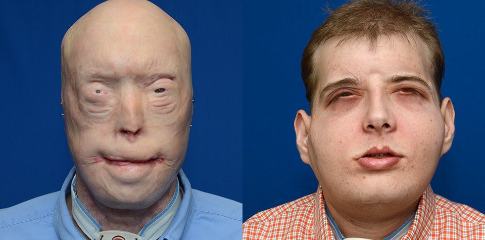 Patrick Hardison is picture before surgery, and then after surgery on Wednesday.