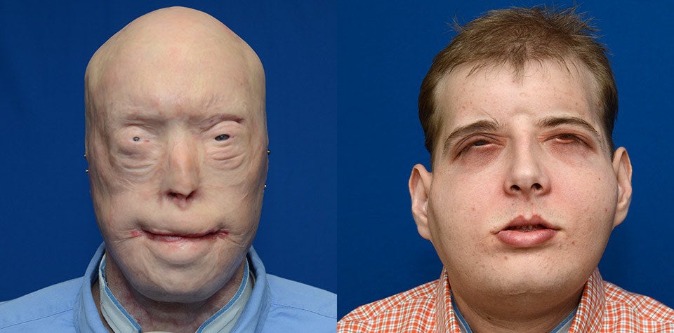Patrick Hardison is picture before surgery, and then after surgery on Wednesday.