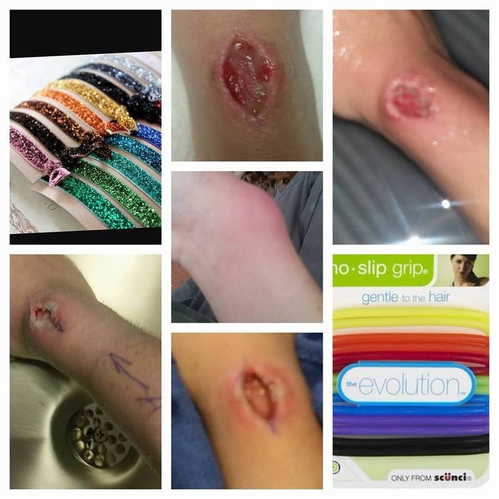 This Woman S Hair Tie Gave Her An Infection That Needed Emergency