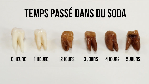 L'enveloppe extérieure de vos dents est enrobée d'émail, formée à partir de minéraux. L'émail est la substance la plus dure du corps humain, mais, malheureusement, la plus encline à se décomposer. Les boissons acides, comme les jus de fruits et les boissons gazeuses, peuvent briser cet émail, rendant vos dents vulnérables aux caries.À moins que vous ne passiez une journée complète (ou cinq) avec du Coca dans la bouche, vous n'atteindrez pas le pourrissement spectaculaire que l'on peut voir dans la photo ci-dessus. Mais une étude a exposé 20 dents à différentes boissons, comme le Coca-Cola, le Pepsi et le Dr. Pepper, leur version light, et d'autres boissons sans alcool. Les résultats ont montré que l'eau du robinet et le café noir ne dissolvent presque pas l'émail, alors que les colas «dissolvent l'émail jusqu'à 55-65 fois plus que l'eau et la "root beer" (un soda très populaire en Amérique du Nord ndlr).»L'étude démontre également qu'il n'y a aucune différence en matière d'érosion des dents entre une boisson ordinaire et sa version light. Bien que les boissons light contiennent moins de sucre, elles sont tout aussi mauvaises pour vos dents.Posez donc cette cinquième canette de Coca si vous voulez protéger vos dents.