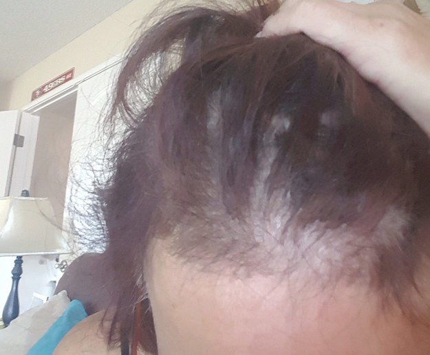 Women Say Their Hair Is Falling Out In Chunks After Using Wen Hair