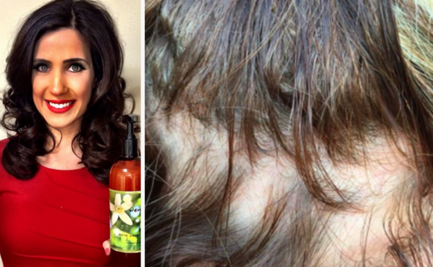 Women Say Their Hair Is Falling Out In Chunks After Using ...