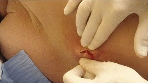 Pimple volcano!