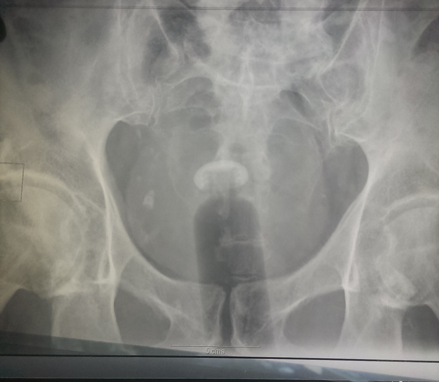 Рентгенограмма полового члена