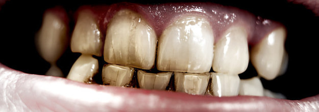 Tamara-Baez-se-puso-cristales-en-los-dientes--como-evitar-caries.htm