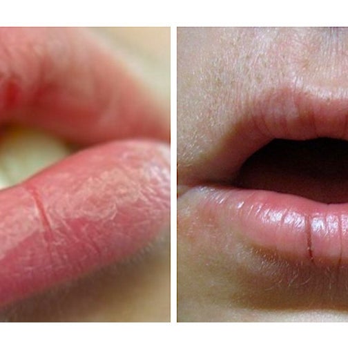 Here's How To Actually Heal Your Dry, Chapped Lips