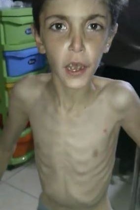 Mohamed Essa, a 7-year-old boy photographed by doctors in Madaya.