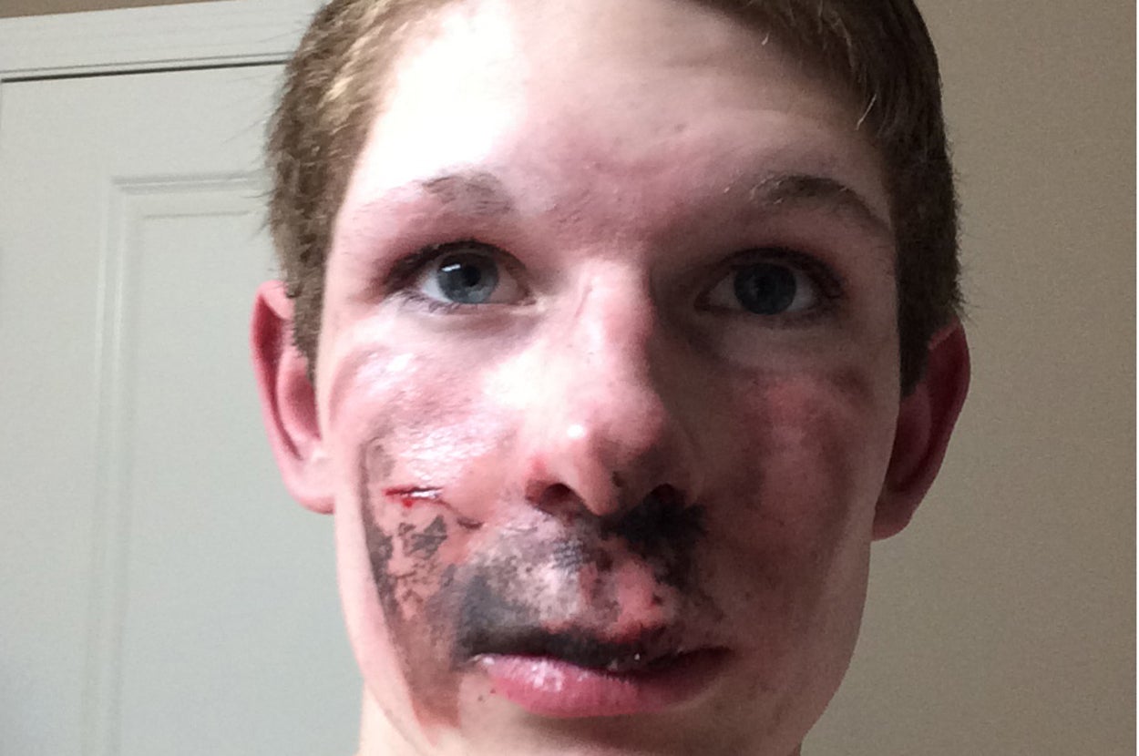 Exploding Cigar Face An Alberta Teenager Found Out What It’s Like When An E-Cigarette ...