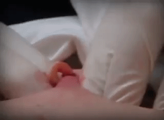 Moist pus plops out with a tad of blood!