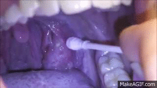 Moist tonsil zit!