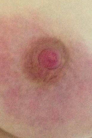 Facebook Says It's Sorry For Censoring A Photo Of A Cancer Patient's Nipple