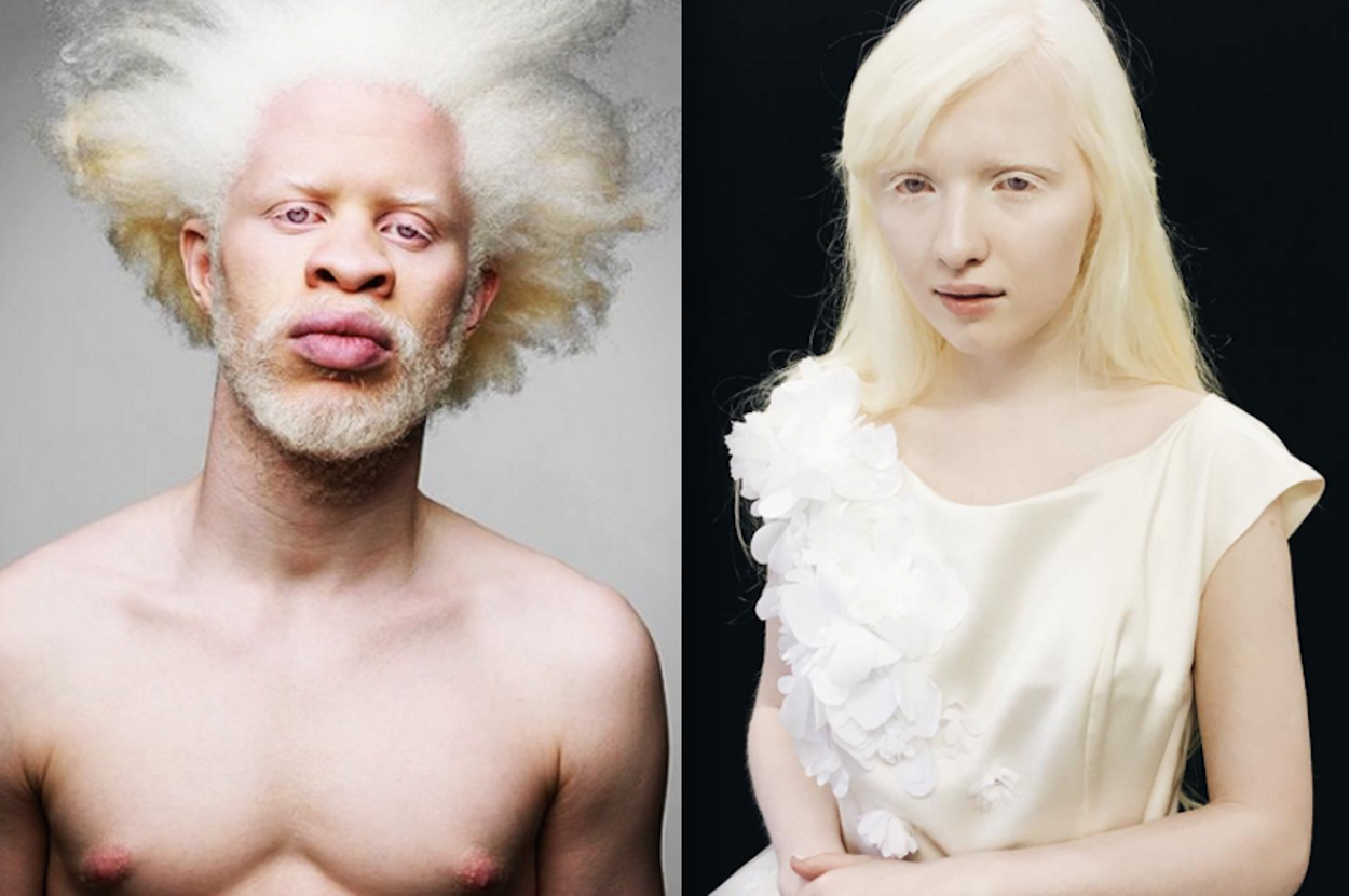 14 Models With Albinism Who Are Taking The Fashion World By Storm