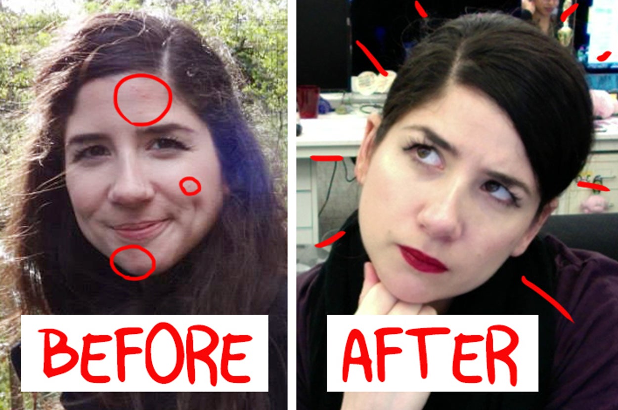 Here’s How I Got Rid Of My Acne Once And For All