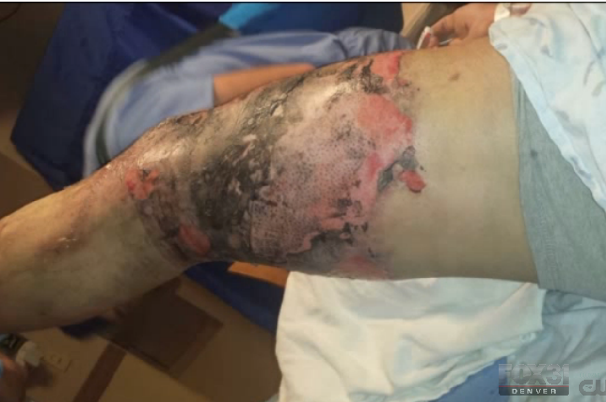This Teen Hopes Photos Of His Severely Burned Leg Will Show Why Vape Pens  Can Be Dangerous
