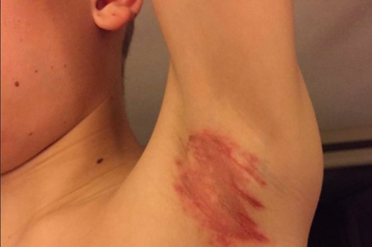 People Say They Are Suffering "Severe Rashes" From Using Old Deodorant