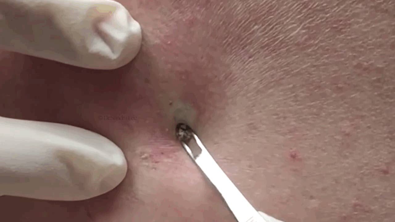 Puedes ver estos GIFs de personas reventando granos sin vomitar?, image size:1280x720