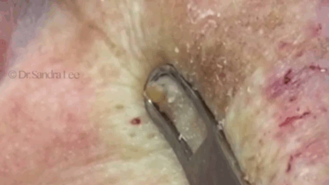 ¿Puedes ver estos GIFs de personas reventando granos sin vomitar?, image size:1280x720