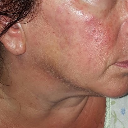 neutrogena causes acne