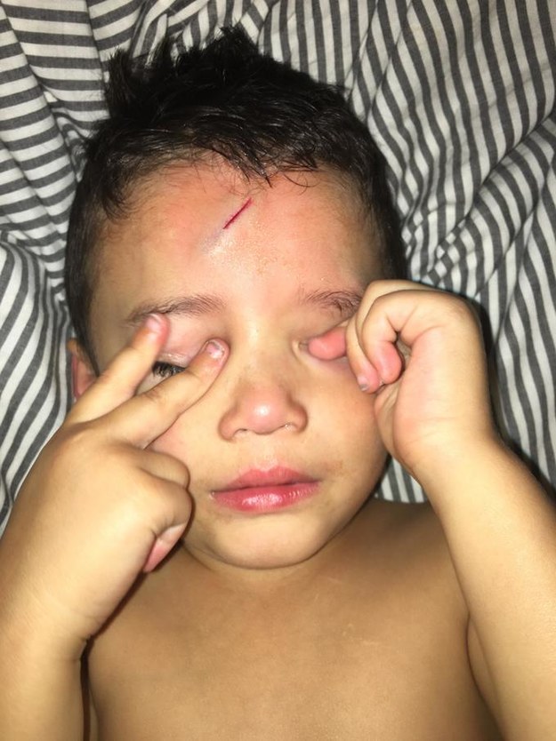 Ayden had an unfortunate fall last Tuesday night. He jumped on a pile of laundry and cut his forehead on the side of the bed frame.
