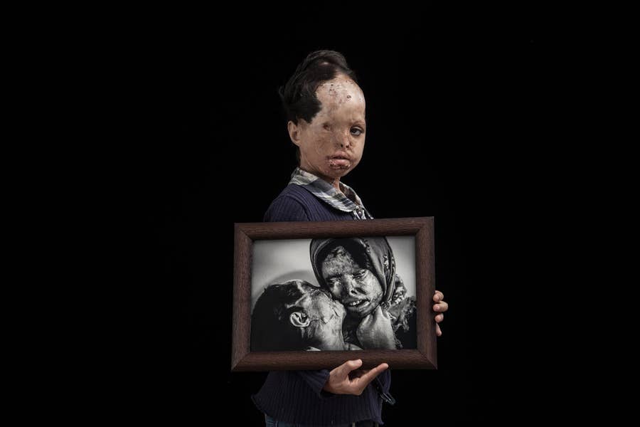 写真 酸を顔にかけられた人たち そのありのままの姿