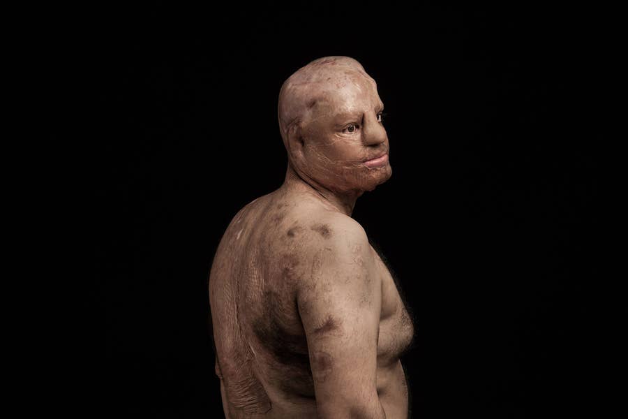 写真 酸を顔にかけられた人たち そのありのままの姿