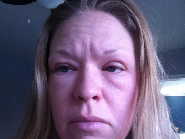 Allergic reaction to face wash swollen eyes