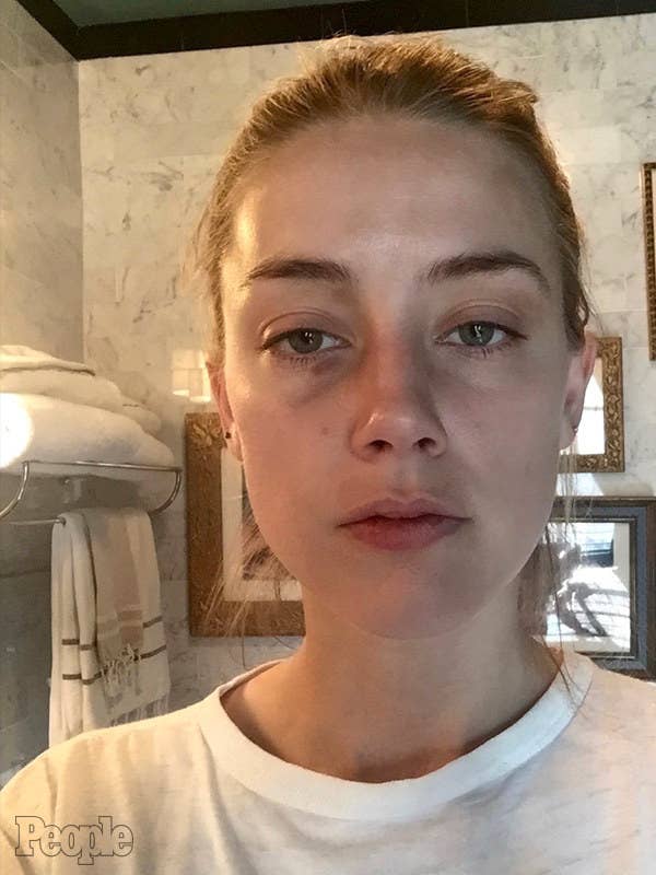 New Photos Show Amber Heard With Other Injuries Allegedly Caused By Johnny Depp